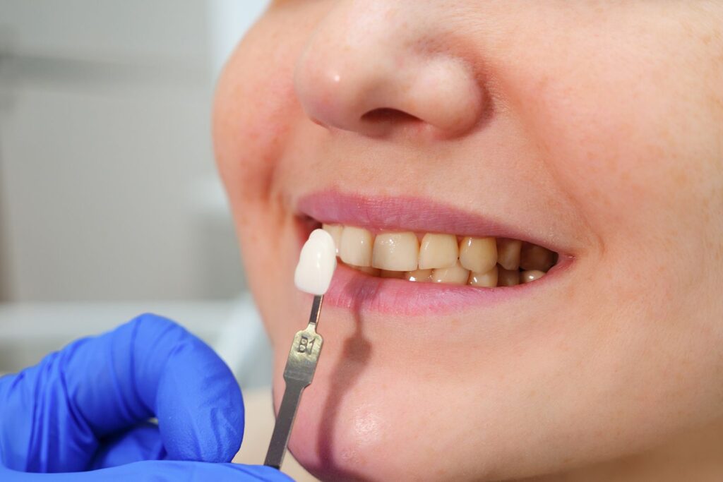 Carillas dentales de Porcelana: Tu Sonrisa Transformada