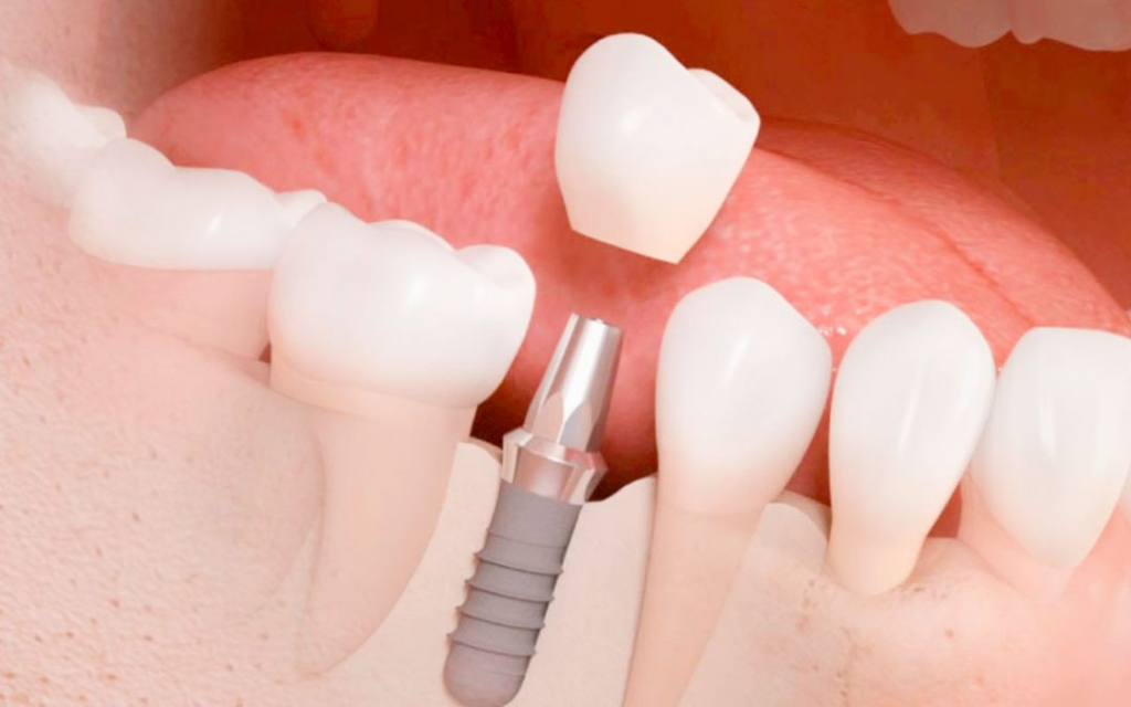 Clínica dental en Guatemala-Servicio de Implantes Dentales
