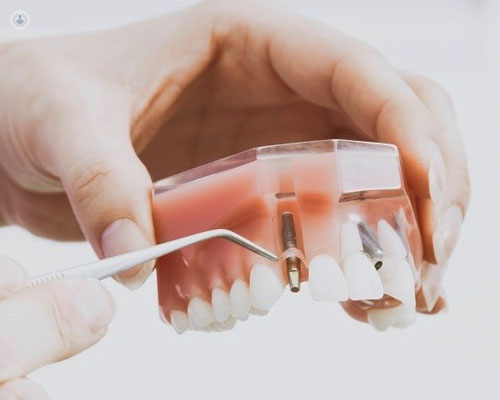 Implantes Dentales Personalizados: La Revolución en la Odontología Moderna