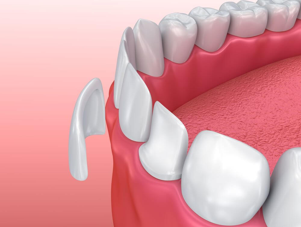 Carillas Dentales de Composite: La Innovación que Sonríe
