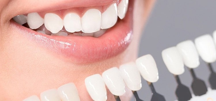 Clínica dental en Guatemala-Servicio de Carillas Dentales estéticas