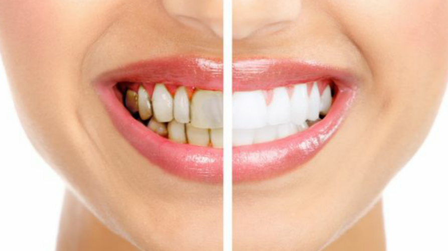 Qué es la Periodontitis y cómo puede afectar tus dientes?