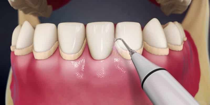 Clínica dental en Guatemala-Limpieza dental profunda