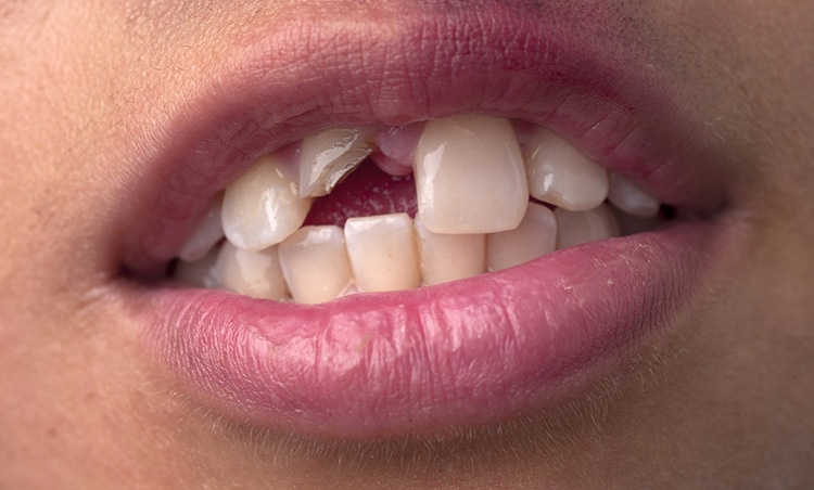 Emergencias Dentales: Acciones Urgentes para Proteger tu Sonrisa