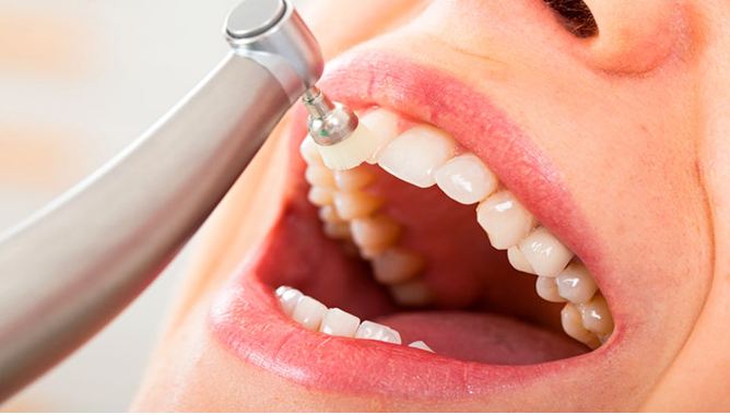 Clínica dental en Guatemala Servicio de Limpieza dental