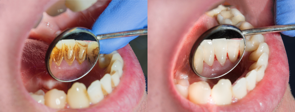 Dientes con sarro vs dientes limpios