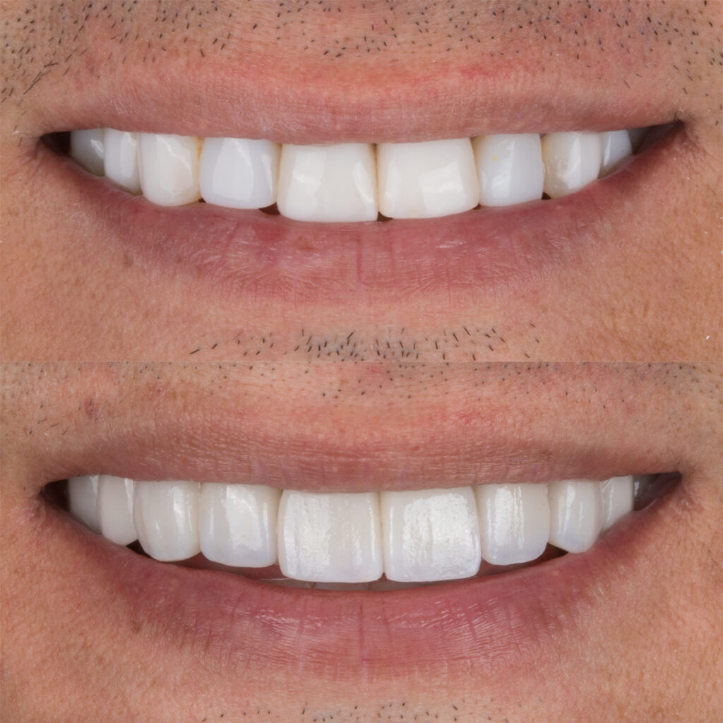 El secreto detrás de sonrisas eternas: Carillas dentales y su durabilidad