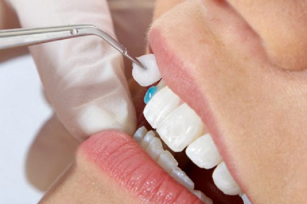 Carillas dentales: Qué son y cuándo utilizarlas?