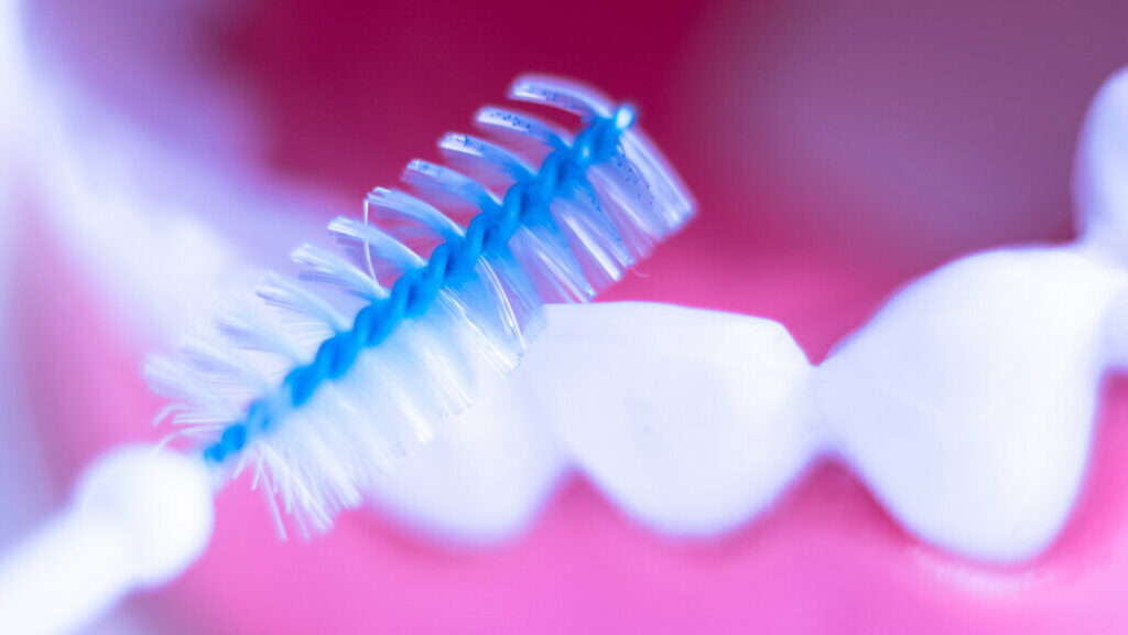 ¿Cuál es la duración estimada de las carillas dentales?