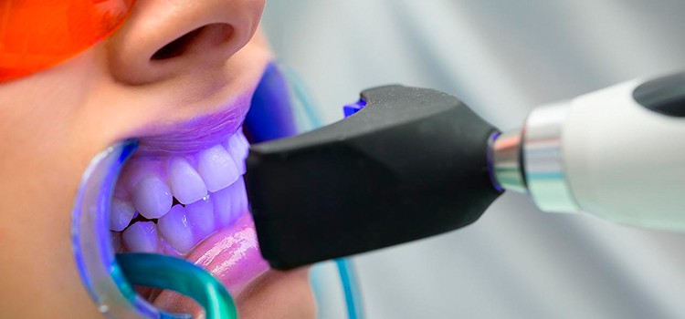 Blanqueamiento dental: Luce una sonrisa perfecta