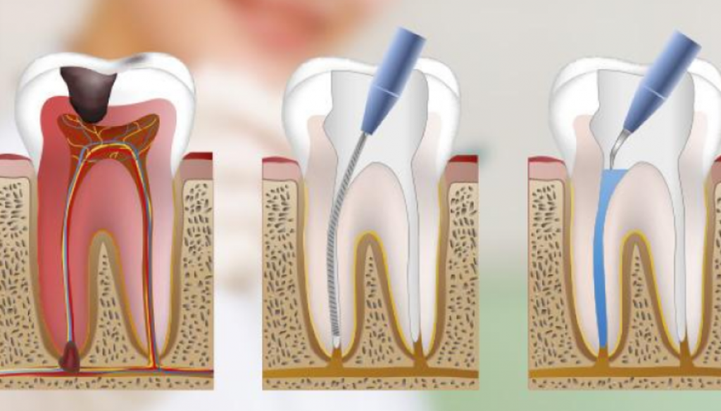 Clínica dental en Guatemala-Servicio de endodoncia multirradicular