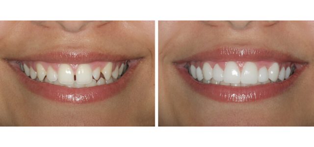 joven utilizando carillas dentales