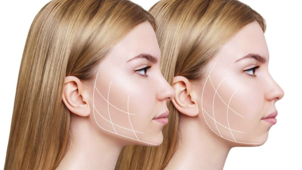 Bichectomía: Esculpiendo tu Belleza Facial