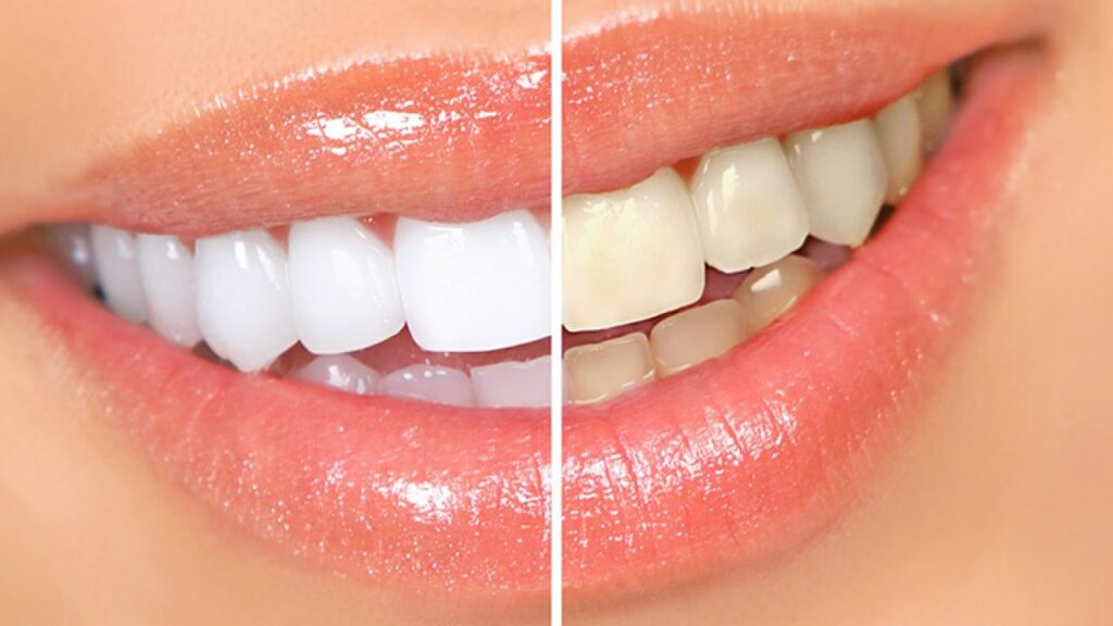 Clínica dental en Guatemala-Servicio de Blanqueamientos Dentales