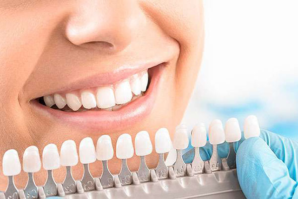 Básicamente cuándo pueden utilizarse carillas dentales?