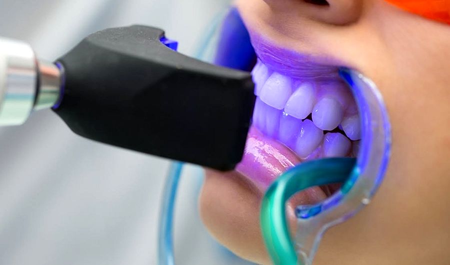 Blanqueamiento dental Profesional