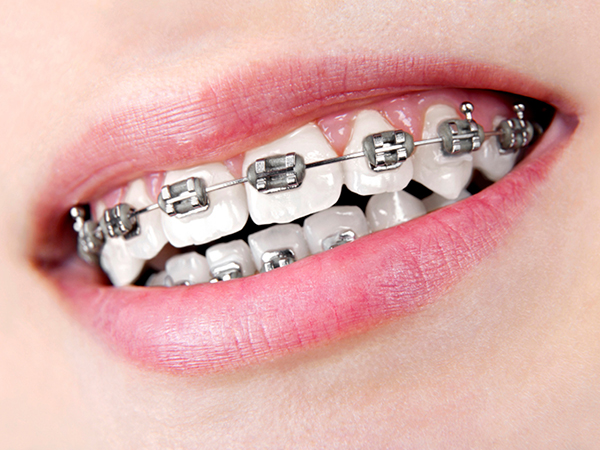 Brackets estéticos vs Brackets metálicos