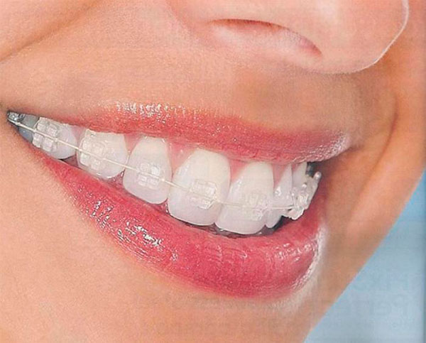Brackets de Zafiro