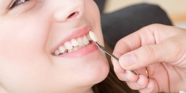 Cómo saber si necesitas carillas dentales