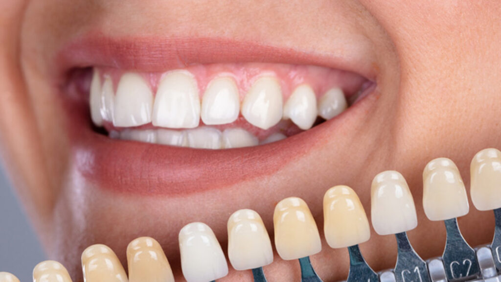 Principales beneficios de las carillas dentales
