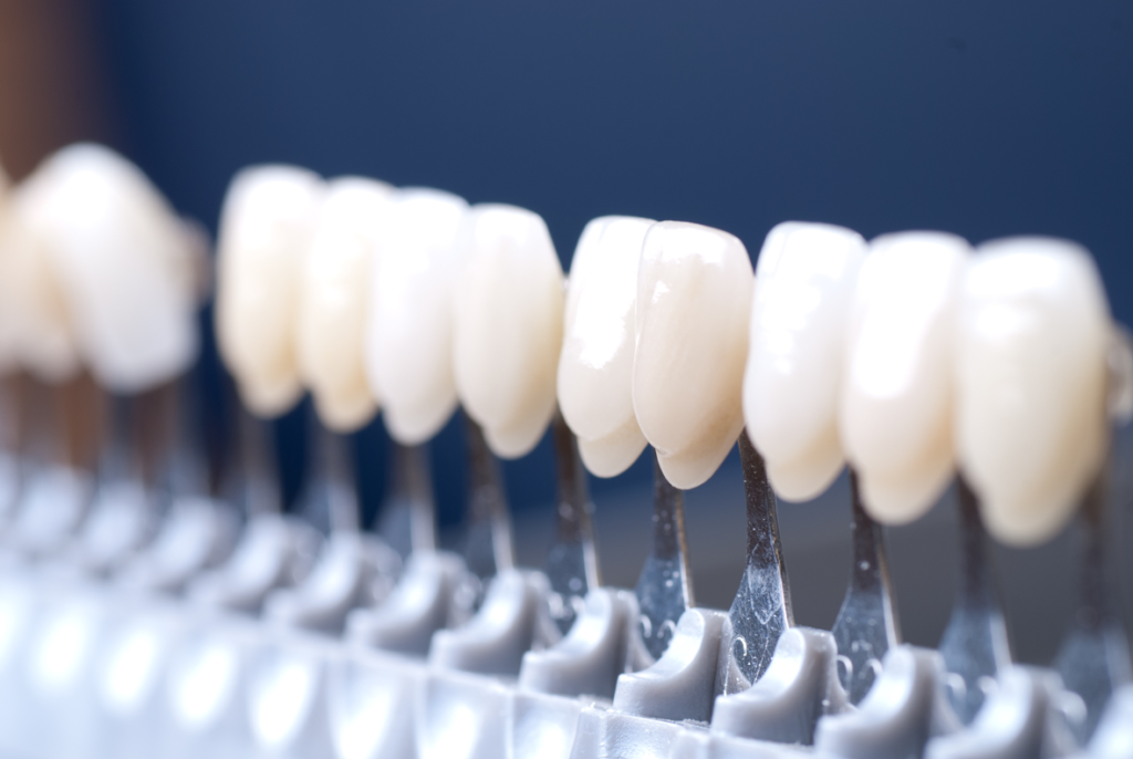 Carillas dentales: tu sonrisa perfecta al instante
