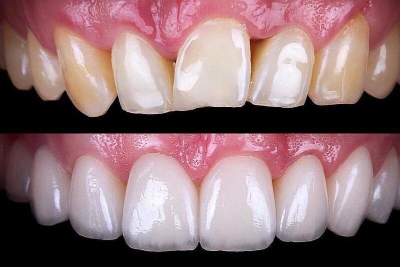 Clínica dental en Guatemala Servicio de Carillas Dentales
