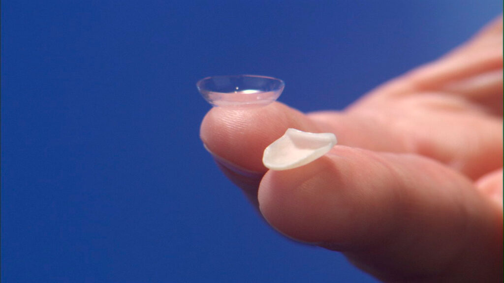 Carillas dentales ultrafinas: La nueva era de la estética dental