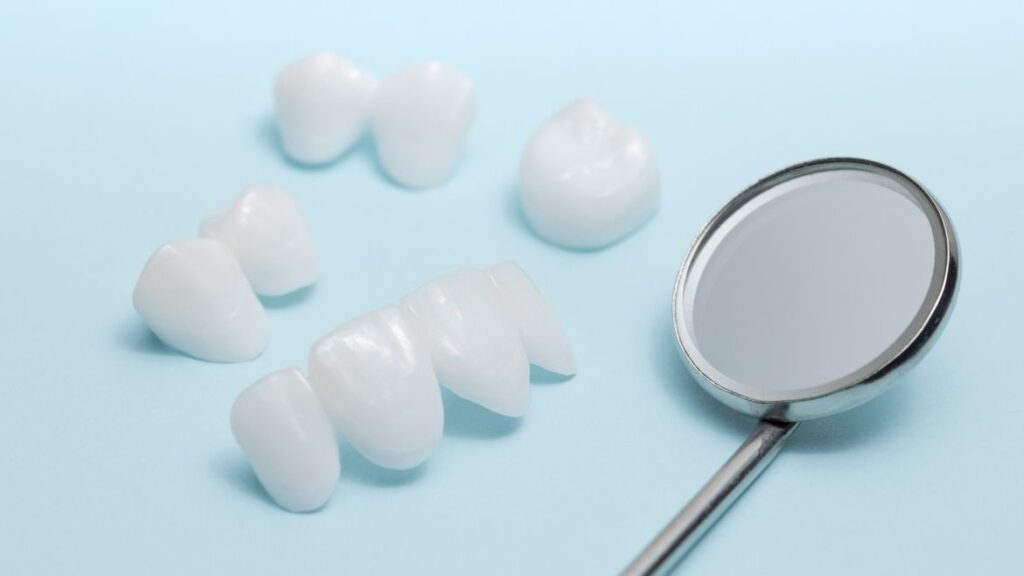 Existen diferencias entre Carillas y Coronas dentales?