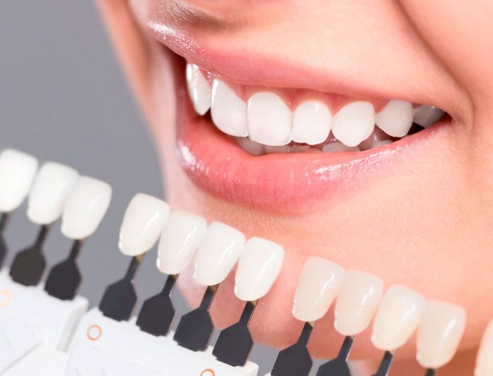 ¿Cuál es la durabilidad de las carillas dentales de composite?