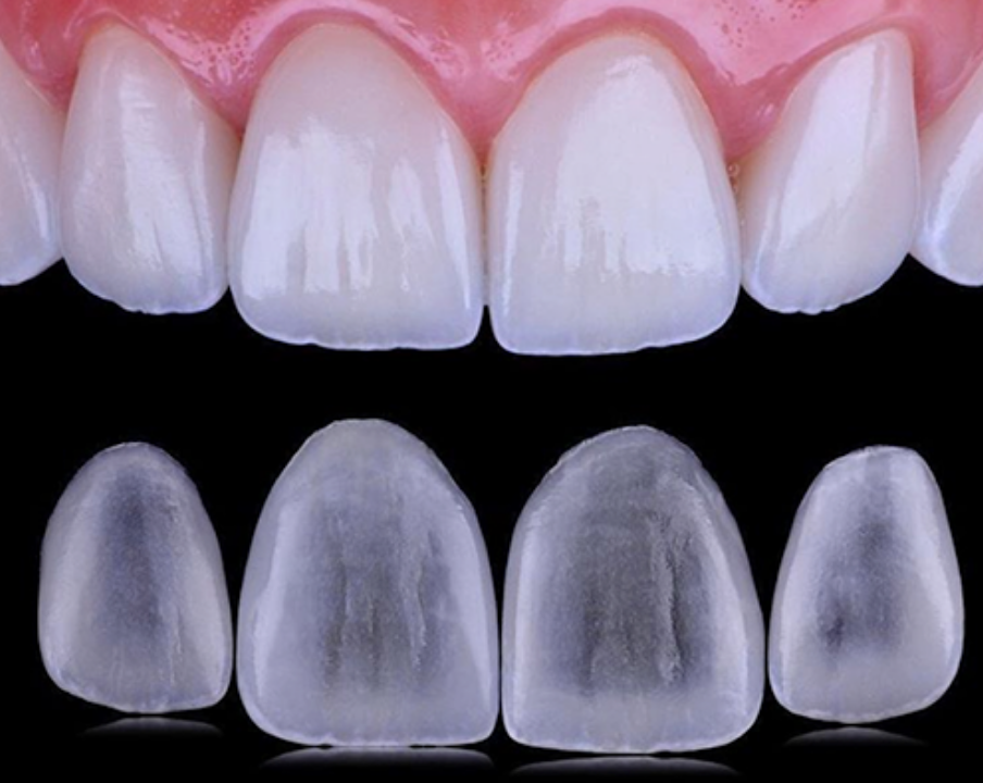 Carillas Dentales de Porcelana o Composite: Cuáles elijo?