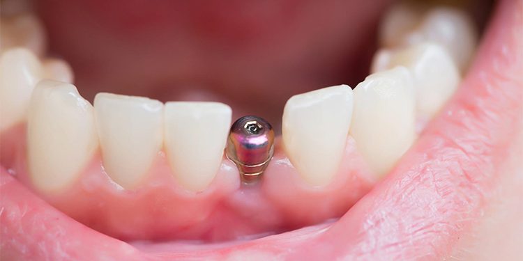 Necesitas un Implante Dental?