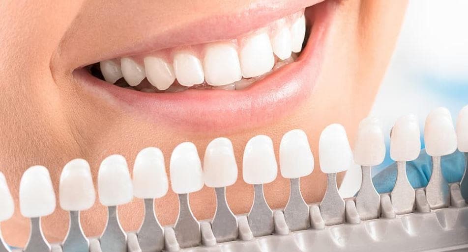 Muestrario  de color para carillas dentales