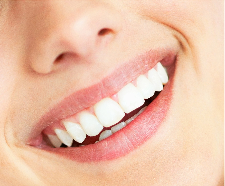 Carillas dentales de porcelana y composite: Una para cada necesidad