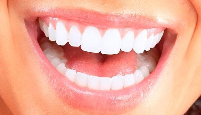 Sonrisa perfecta con carillas dentales