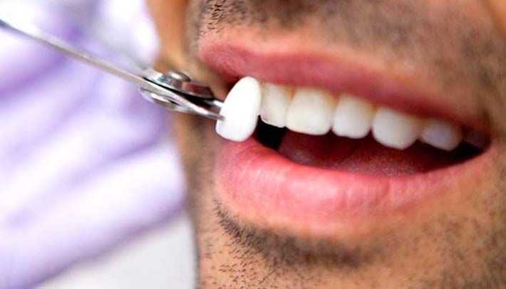 Carillas dentales: Tipos y materiales