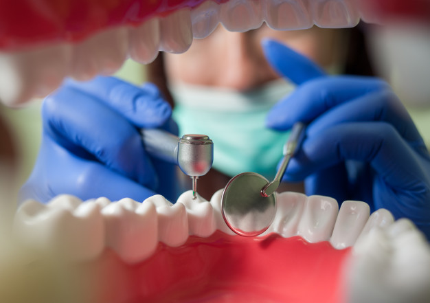 Clínica dental en Guatemala-Endodoncia unirradicular