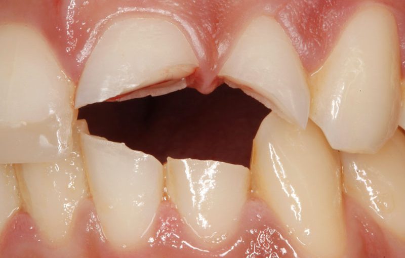 Emergencias Dentales: Qué Hacer en Casos Críticos