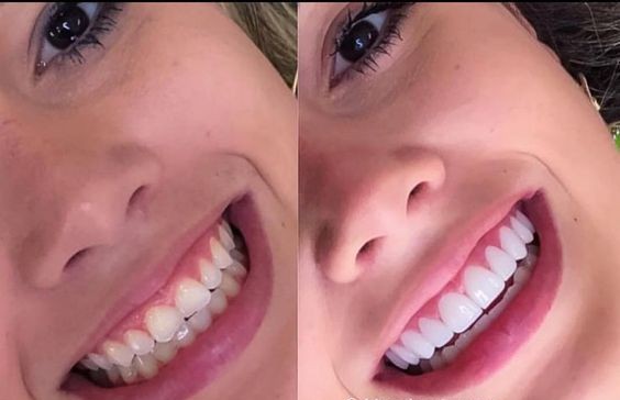 Carillas de Porcelana vs Composite