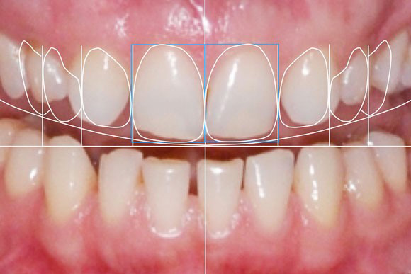 Procedimiento de diseño de sonrisa