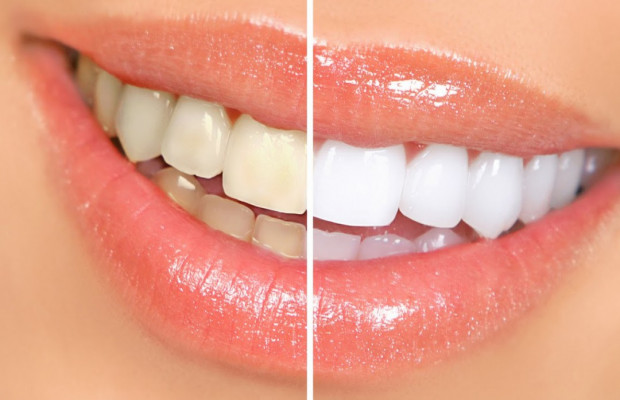 Clínica dental en Guatemala-Blanqueamientos dentales profesionales