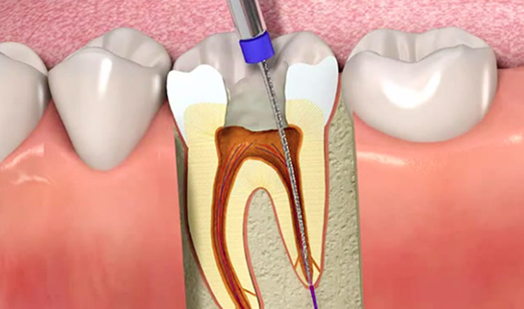Clínica dental en Guatemala-Servicio de Endodoncia