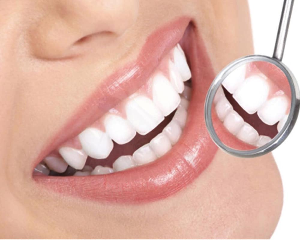 Carillas dentales: La clave de sonrisas perfectas desde temprana edad