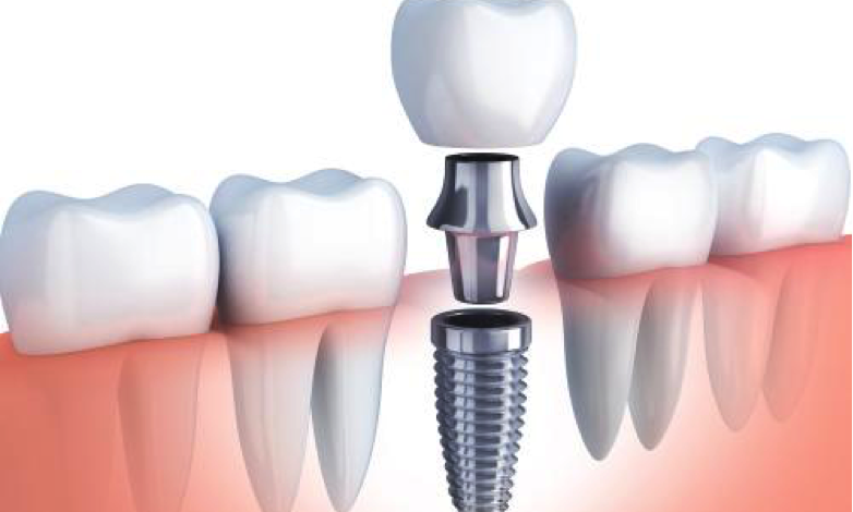 Implantes  Dentales: Una alternativa a las prótesis