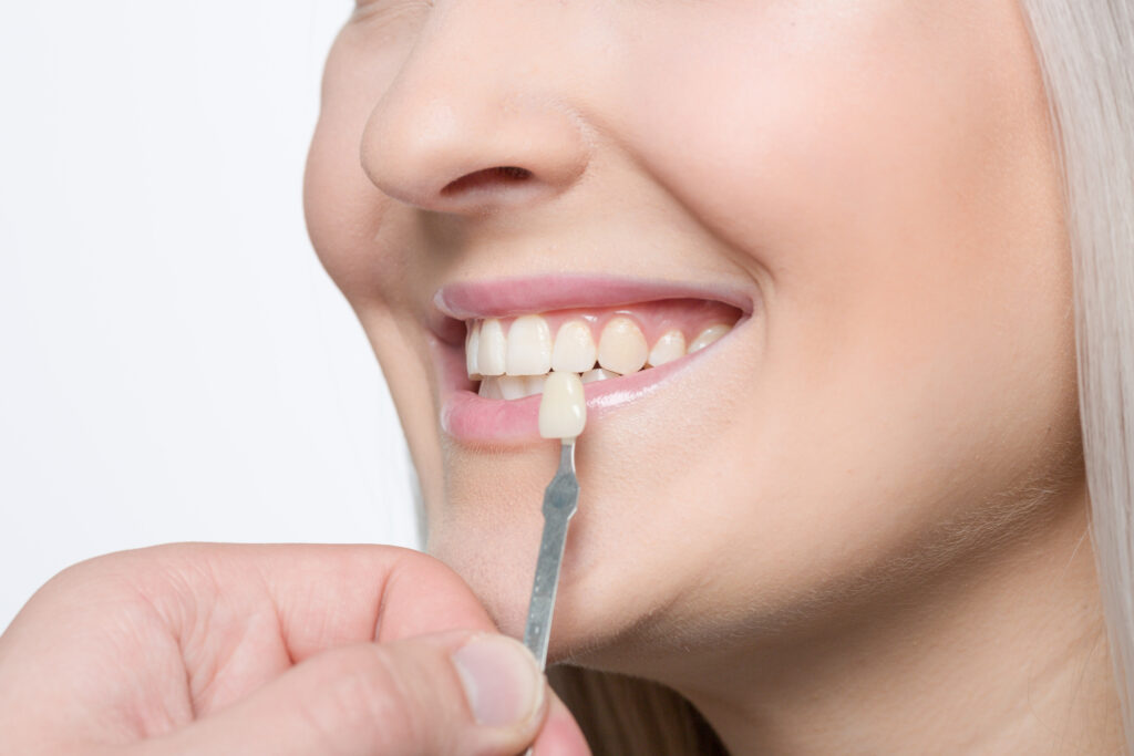 Paciente con carillas dentales