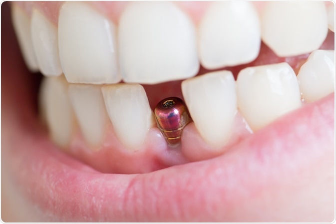 Implante dental