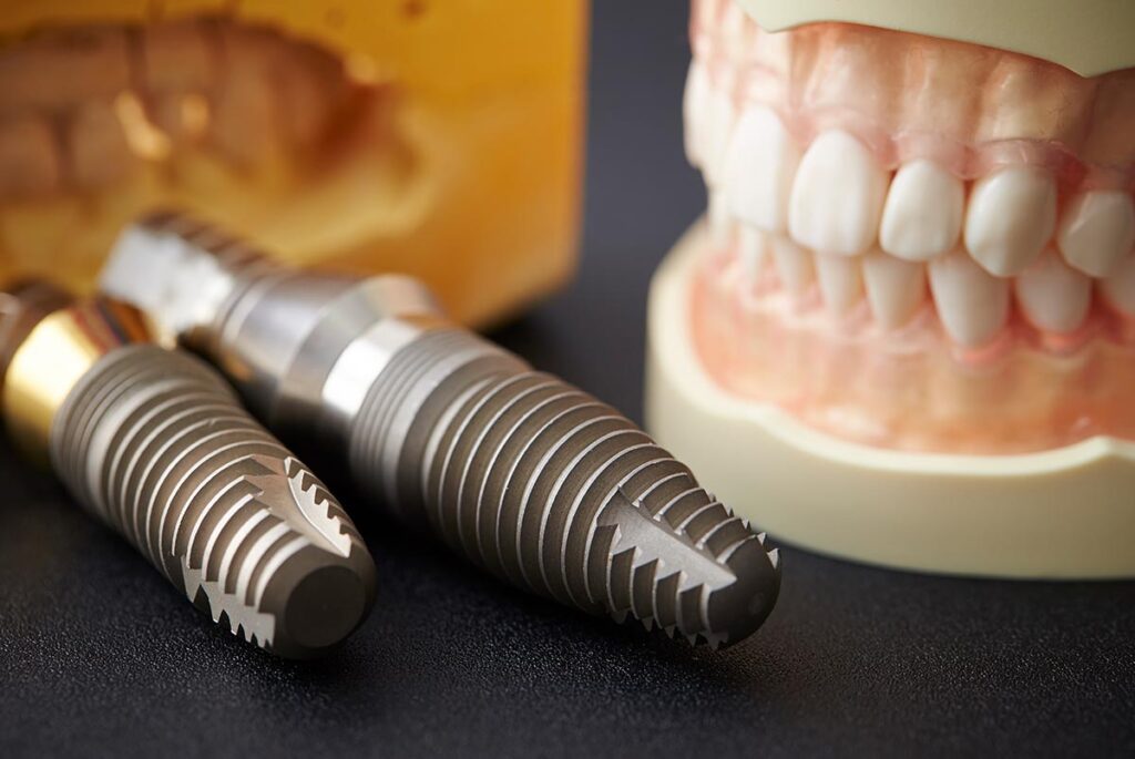 Sonrisa instantánea: Implantes dentales de carga inmediata