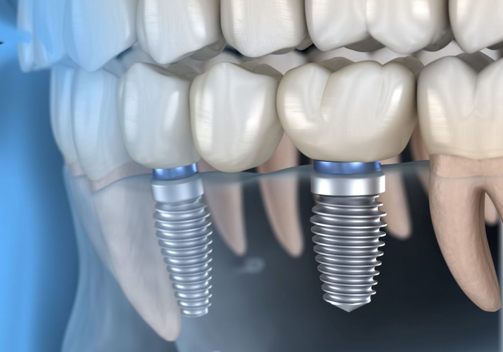 Clínica dental en Guatemala-Servicio de Implantes Dentales tratamiento