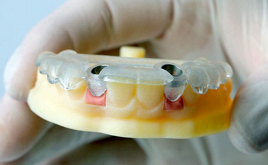 Implantes Dentales 2.0: Hacia una Sonrisa del Futuro