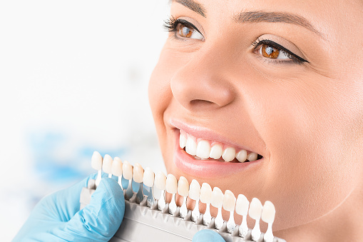 Carillas Dentales: Consigue una sonrisa perfecta