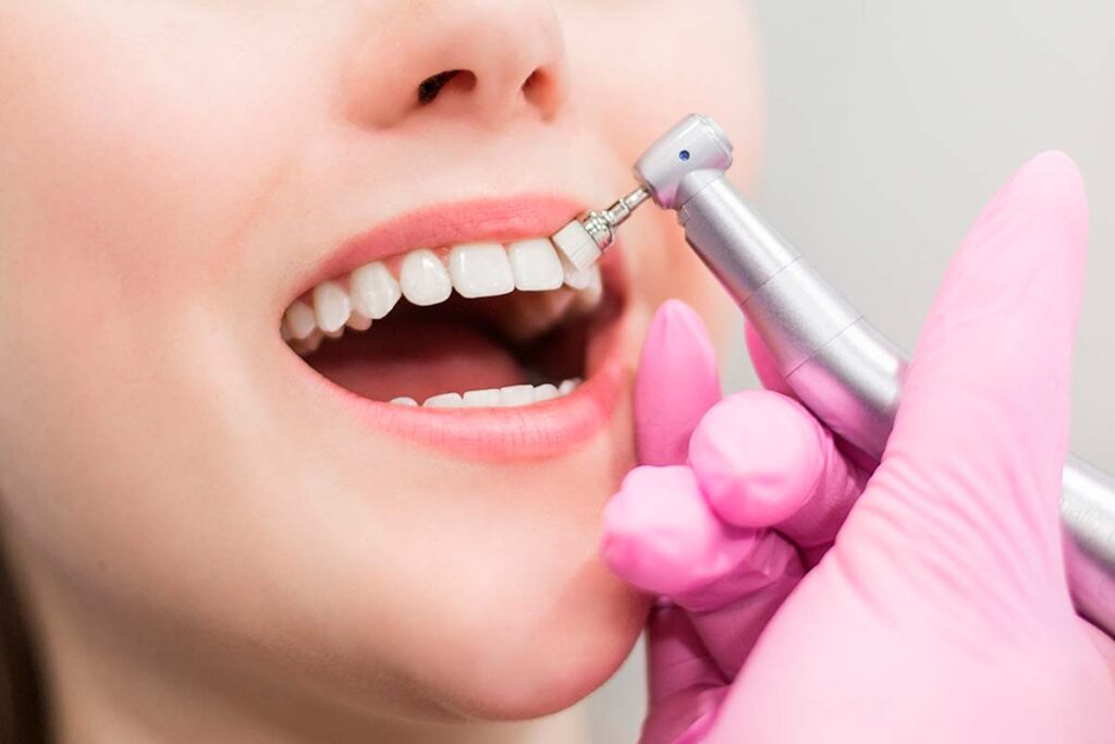 Limpieza dental profesional: En qué consiste?